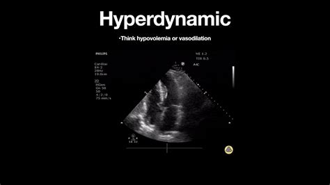 is hyperdynamic left ventricle serious